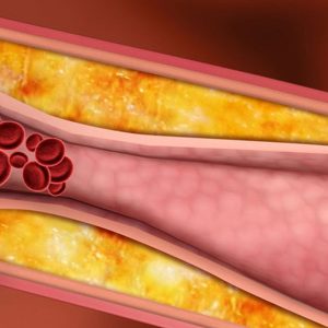 lts-analisis-clinicos-Dislipidemias